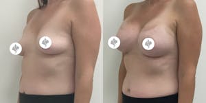 This is one of our beautiful breast augmentation patient 19