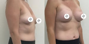 This is one of our beautiful breast augmentation patient 19