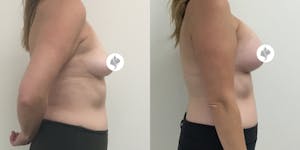 This is one of our beautiful breast augmentation patient 19