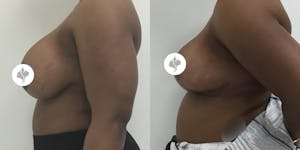 This is one of our beautiful breast reduction patient 56