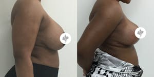 This is one of our beautiful breast reduction patient 56