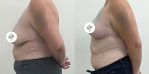 This is one of our beautiful breast reduction patient 58