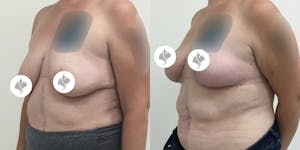 This is one of our beautiful breast reduction patient 58