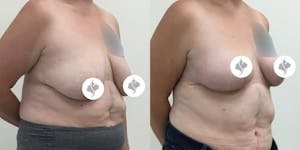 This is one of our beautiful breast reduction patient 58