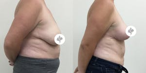 This is one of our beautiful breast reduction patient 58