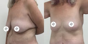 This is one of our beautiful breast reduction patient 57