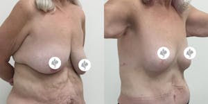 This is one of our beautiful breast reduction patient 57