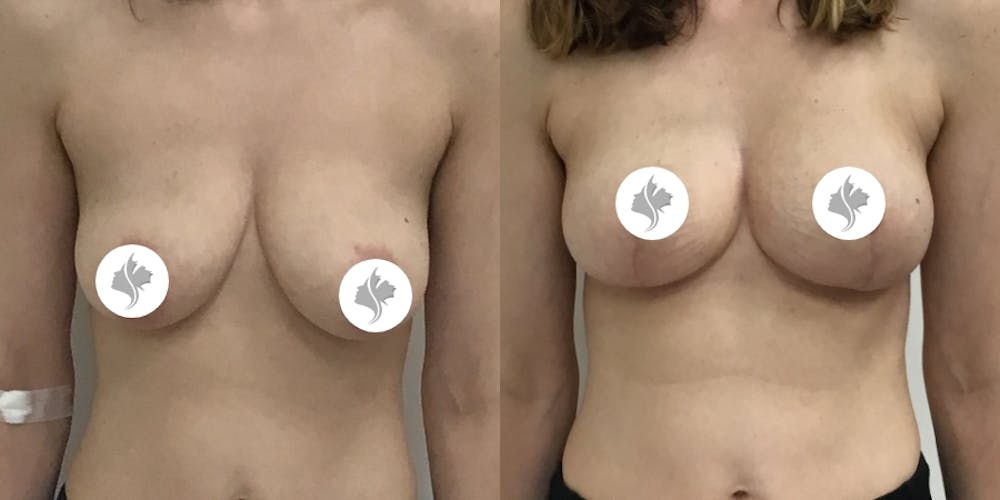 This is one of our beautiful breast asymmetry correction patient #3