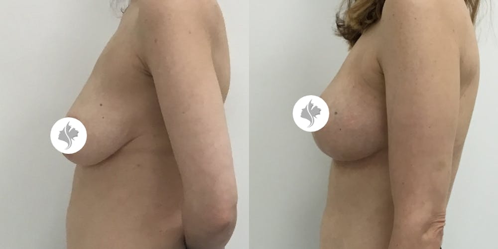 This is one of our beautiful breast asymmetry correction patient #3