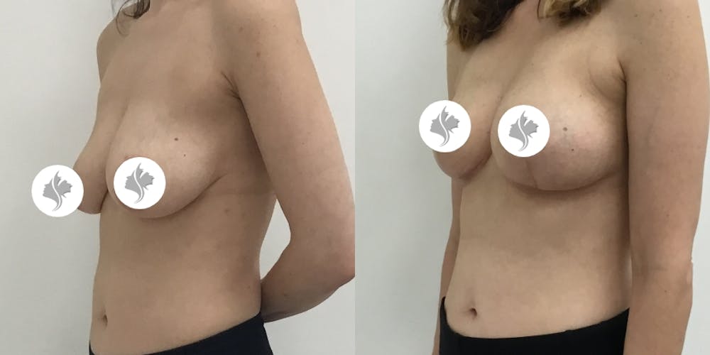 This is one of our beautiful breast asymmetry correction patient #3
