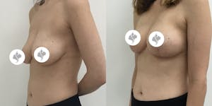 This is one of our beautiful breast asymmetry correction patient 3