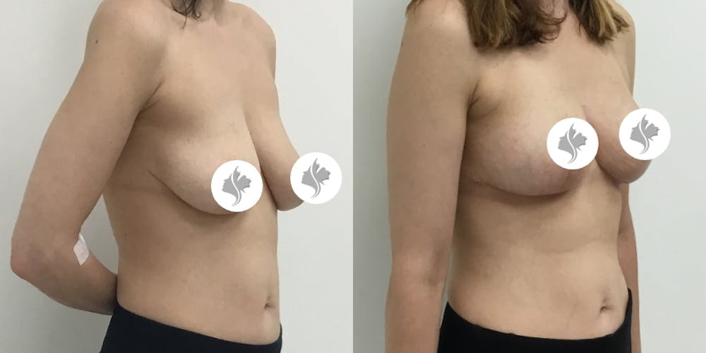 This is one of our beautiful breast asymmetry correction patient #3