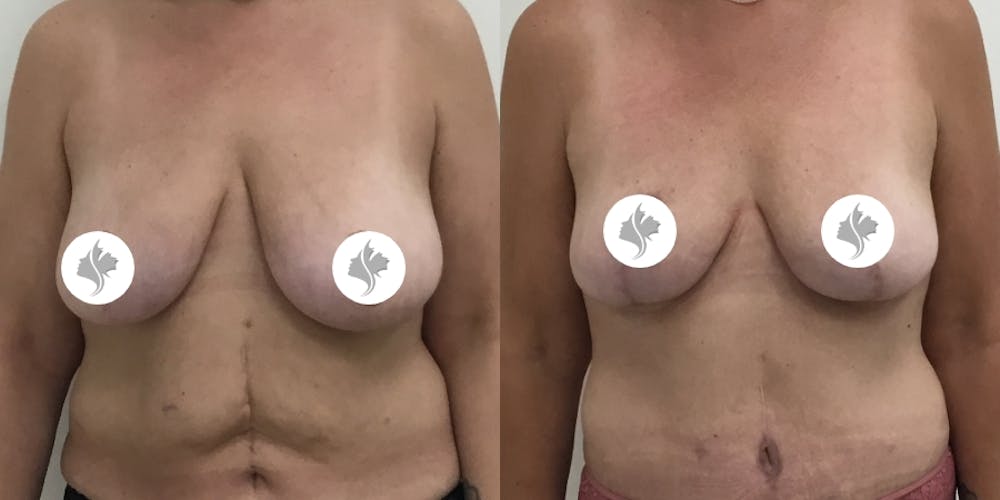 This is one of our beautiful breast reduction patient #61