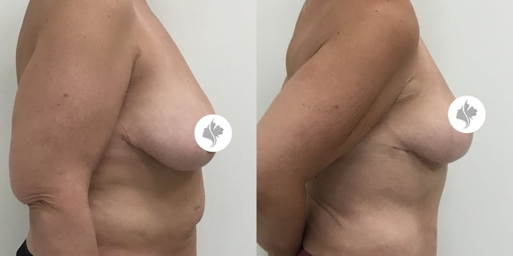 This is one of our beautiful breast reduction patient #61