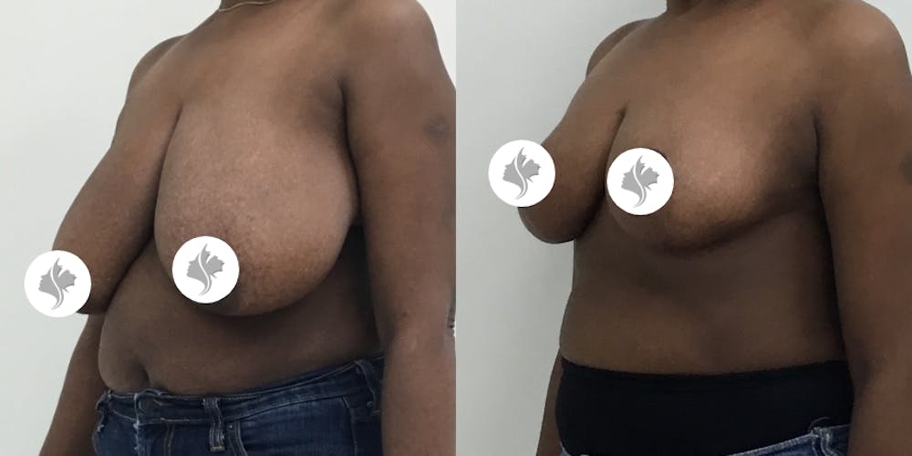 This is one of our beautiful breast reduction patient #6
