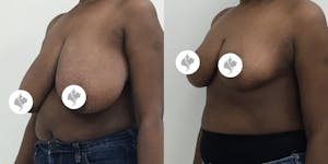 This is one of our beautiful breast reduction patient 6