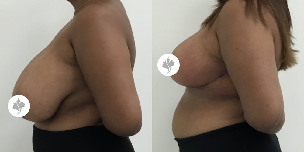 This is one of our beautiful breast reduction patient #62