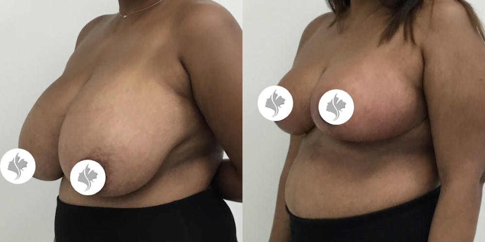 This is one of our beautiful breast reduction patient #62