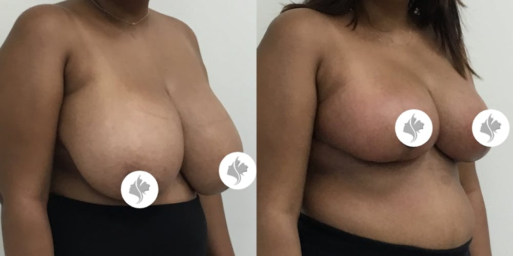This is one of our beautiful breast reduction patient #62