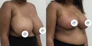 This is one of our beautiful breast reduction patient 62