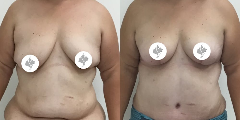 This is one of our beautiful breast reduction patient #63
