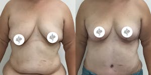 This is one of our beautiful breast reduction patient 63
