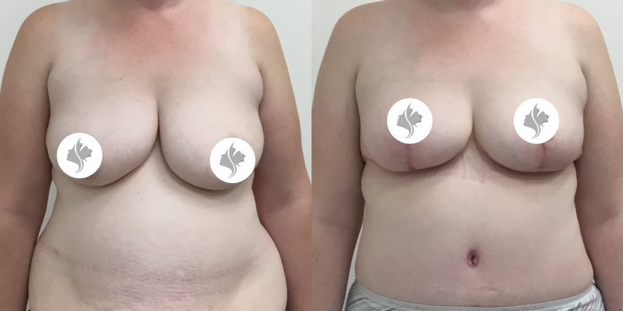 This is one of our beautiful breast reduction patient 64