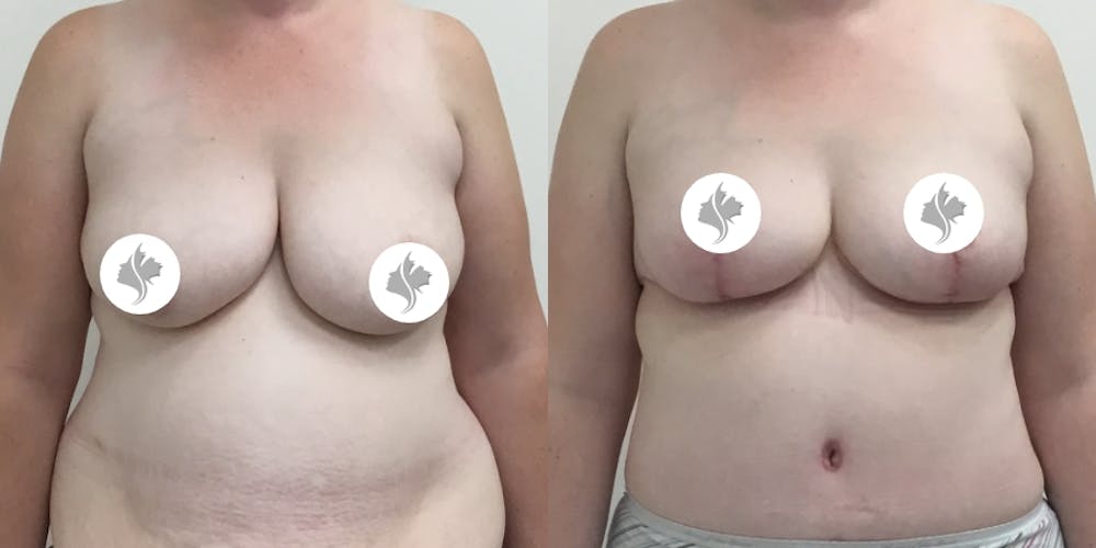 This is one of our beautiful breast reduction patient #64