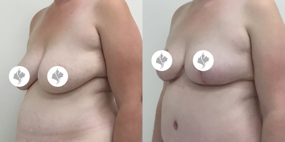 This is one of our beautiful breast reduction patient #64