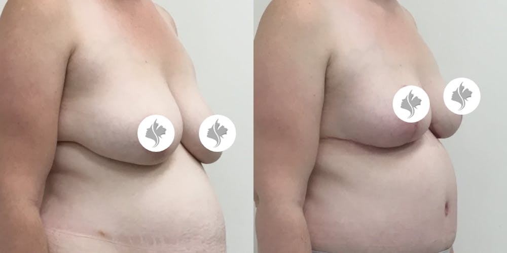This is one of our beautiful breast reduction patient #64