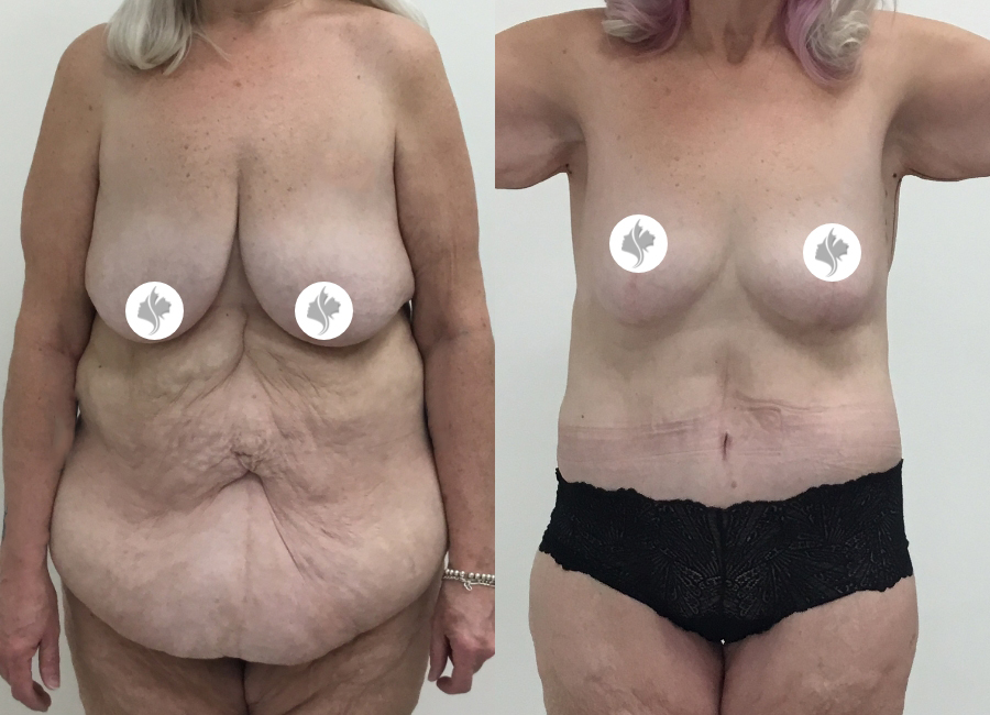 This is one of our beautiful post-bariatric body contouring patient 25
