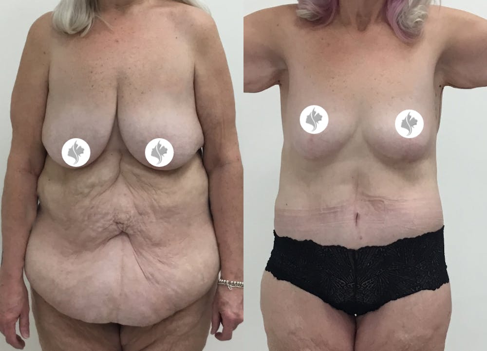 This is one of our beautiful post-bariatric body contouring patient #25