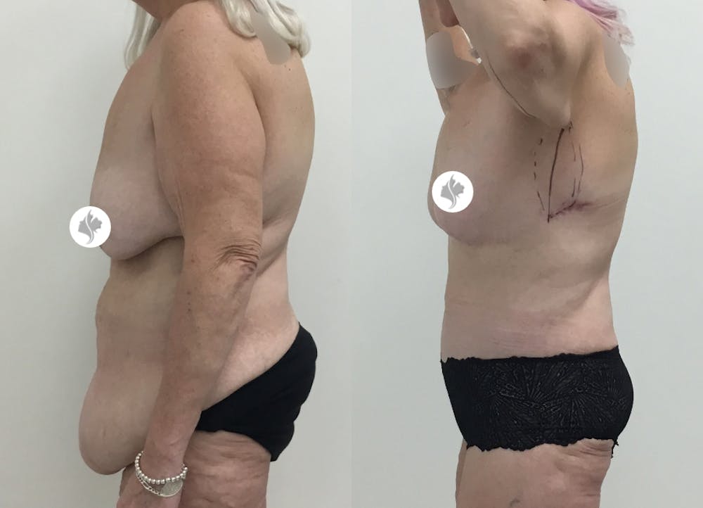 This is one of our beautiful post-bariatric body contouring patient #25