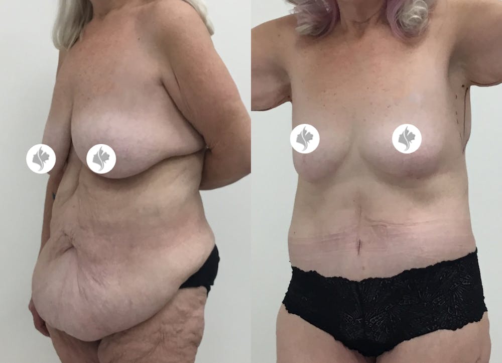 This is one of our beautiful post-bariatric body contouring patient #25