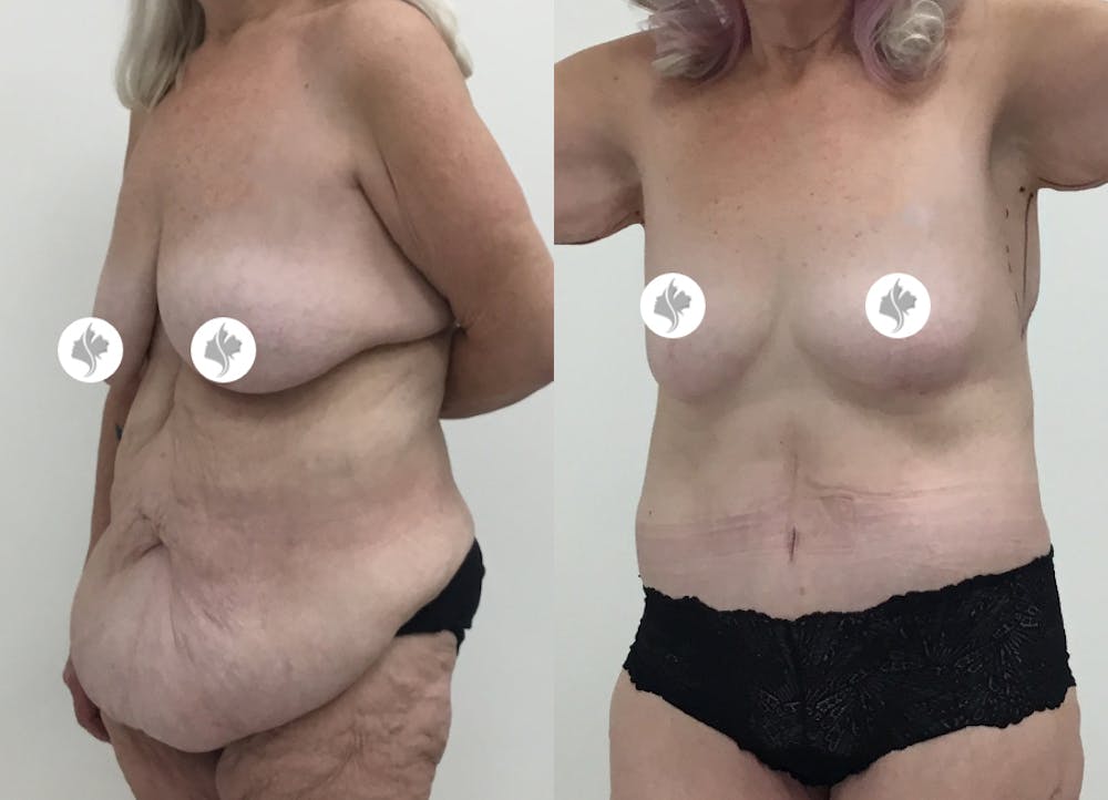 This is one of our beautiful tummy tuck patient #46