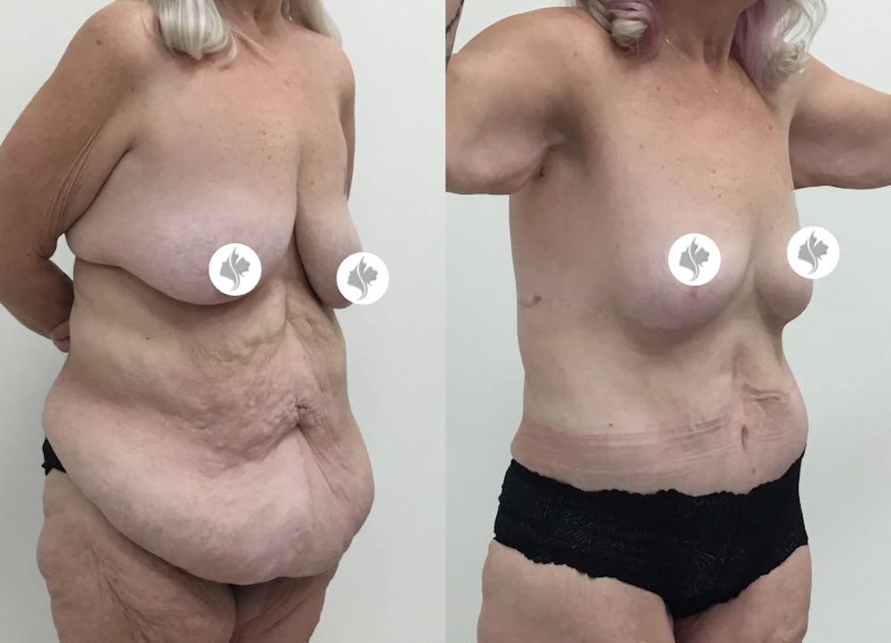 This is one of our beautiful post-bariatric body contouring patient #25