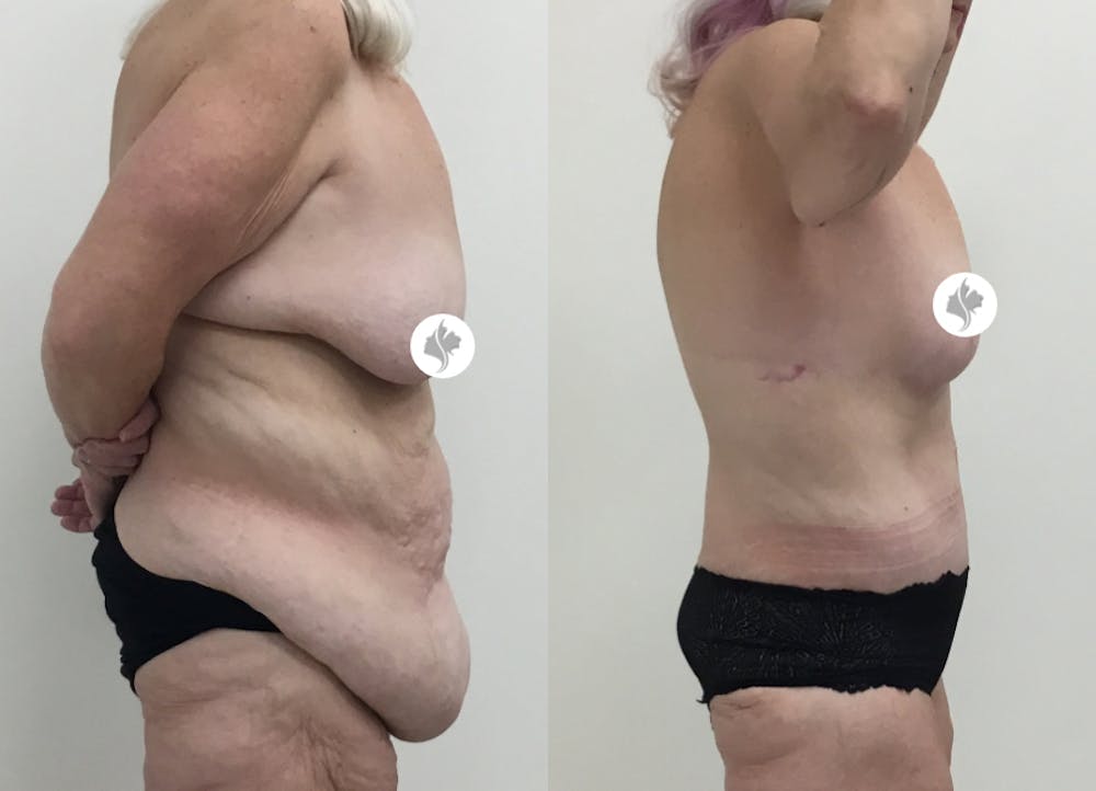 This is one of our beautiful post-bariatric body contouring patient #25