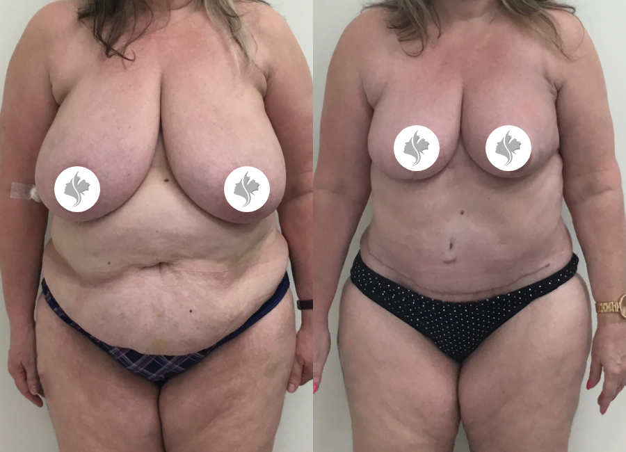 This is one of our beautiful tummy tuck patient 47