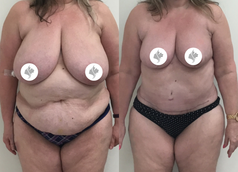 This is one of our beautiful post-bariatric body contouring patient 26