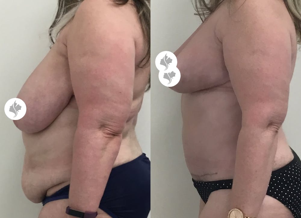 This is one of our beautiful post-bariatric body contouring patient #26