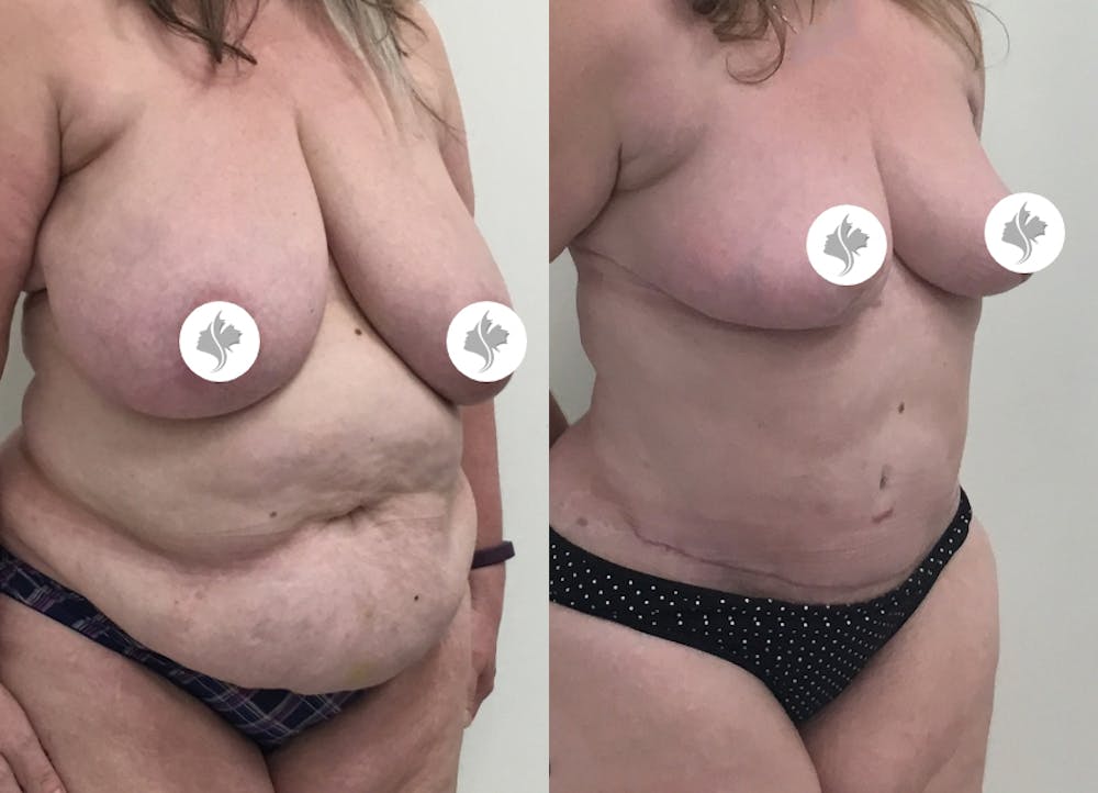 This is one of our beautiful post-bariatric body contouring patient #26