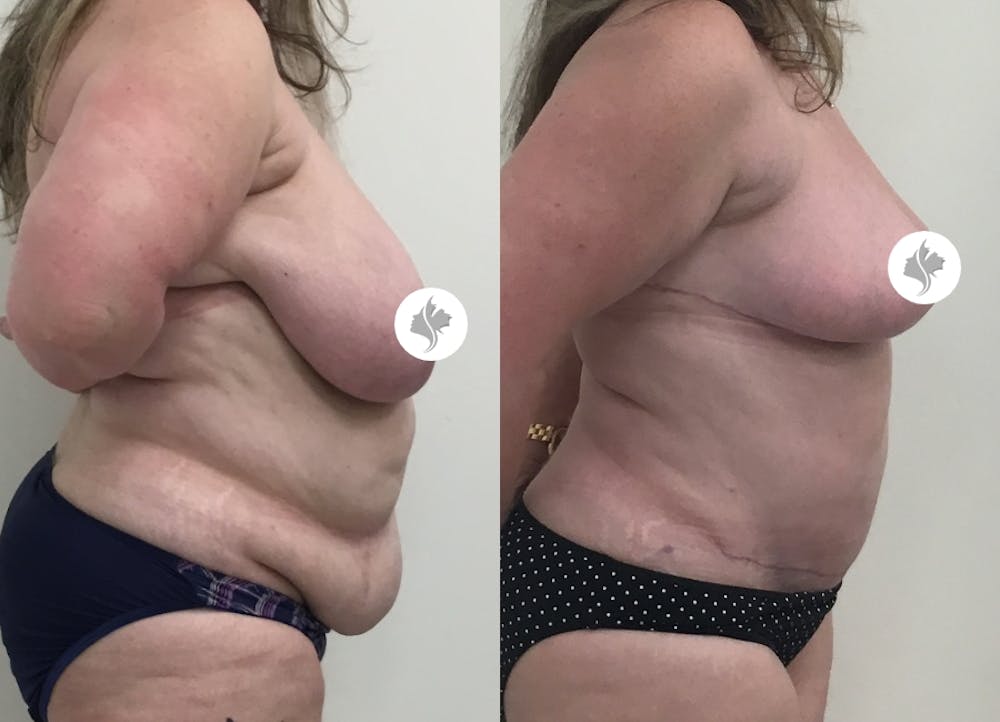 This is one of our beautiful post-bariatric body contouring patient #26