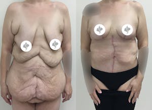 This is one of our beautiful post-bariatric body contouring patient 27