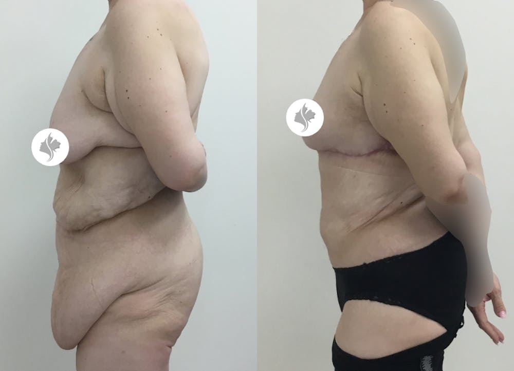This is one of our beautiful tummy tuck patient #48