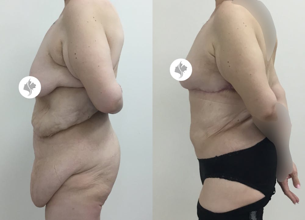 This is one of our beautiful post-bariatric body contouring patient #27