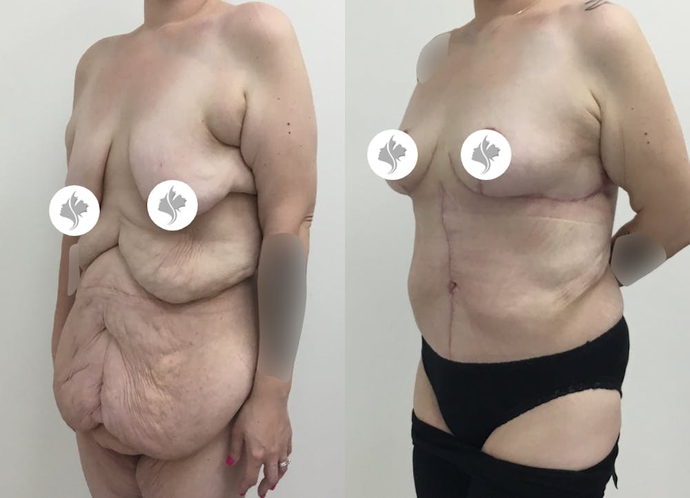 This is one of our beautiful post-bariatric body contouring patient #27