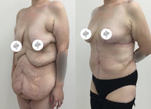 This is one of our beautiful tummy tuck patient 48