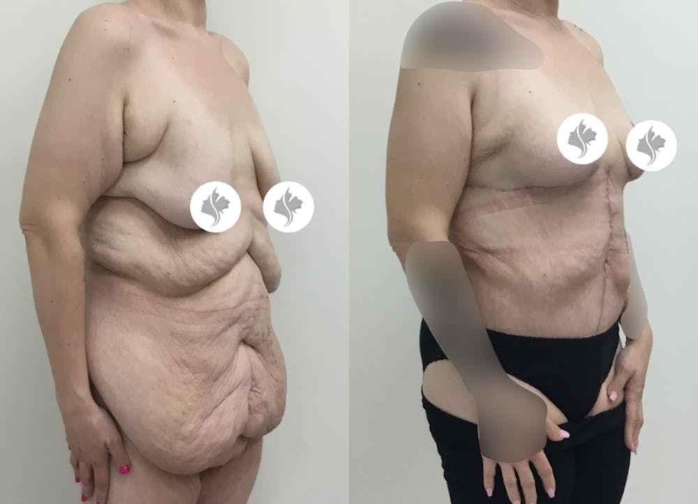 This is one of our beautiful tummy tuck patient #52