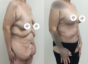 This is one of our beautiful tummy tuck patient 48