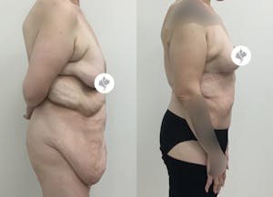 This is one of our beautiful tummy tuck patient 48